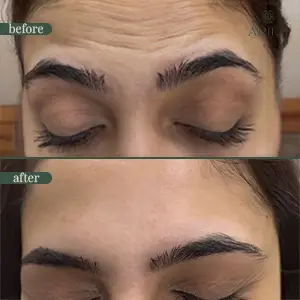 Anti-wrinkle injection before and after result 1