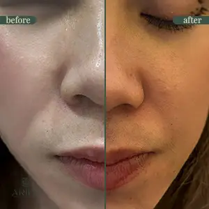 Anti-wrinkle injection before and after result 2