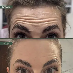 Anti-wrinkle injection before and after result 3