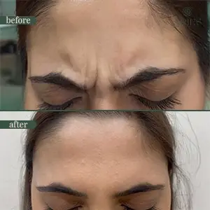 Anti-wrinkle injection before and after result 4